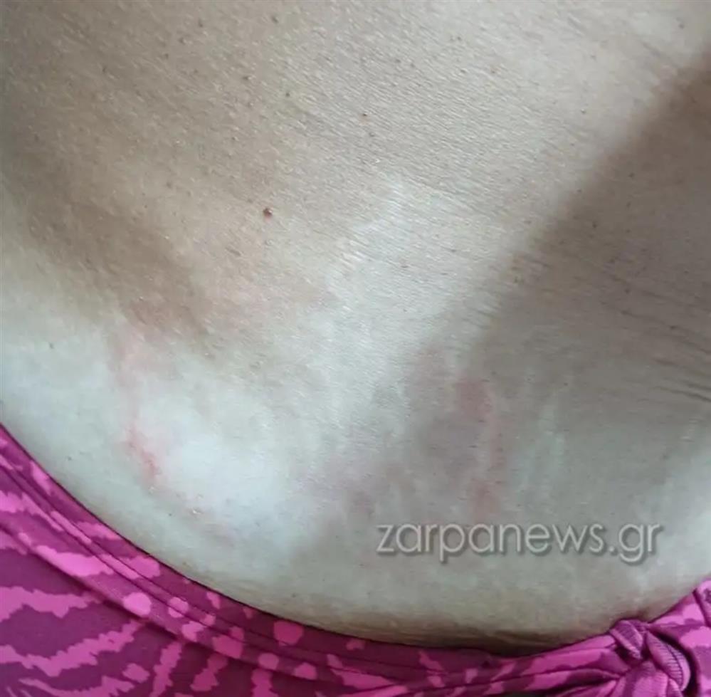 χανια - χελωνα - δαγκωμα