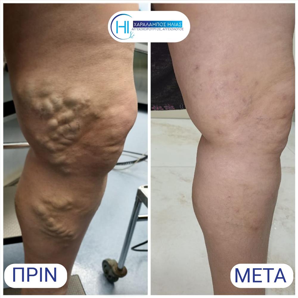 Χαράλαμπος Ηλίας - κιρσοί