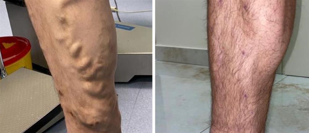 Κιρσοί - ευρυαγγείες