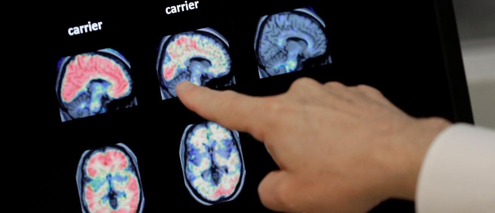 Alzheimer - Αλτσχάιμερ Alzheimer - Αλτσχάιμερ