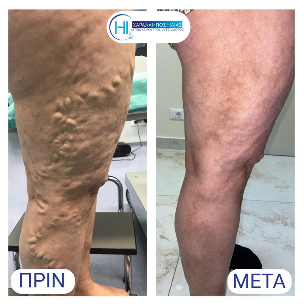 Χαράλαμπος Ηλίας - κιρσοί